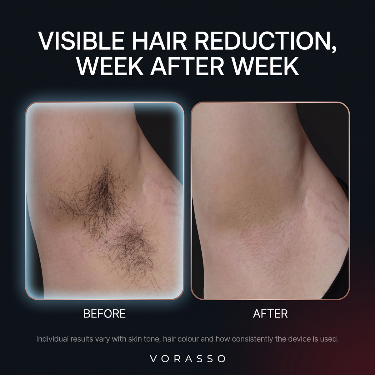 Visible hair reduction week after week, before and after underarm comparison