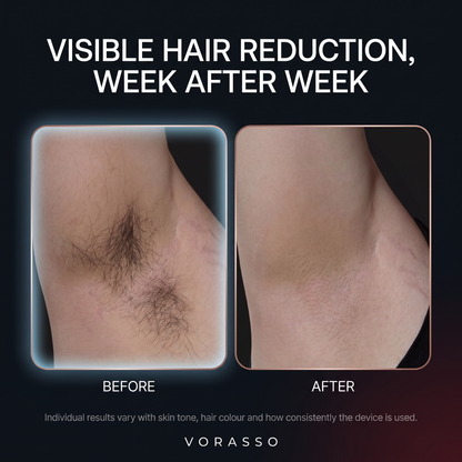Visible hair reduction week after week, before and after underarm comparison
