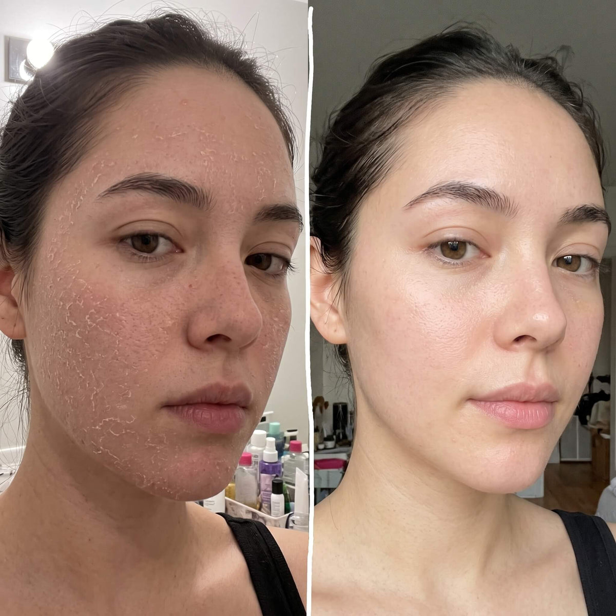 Skin before and after switching to filtered water